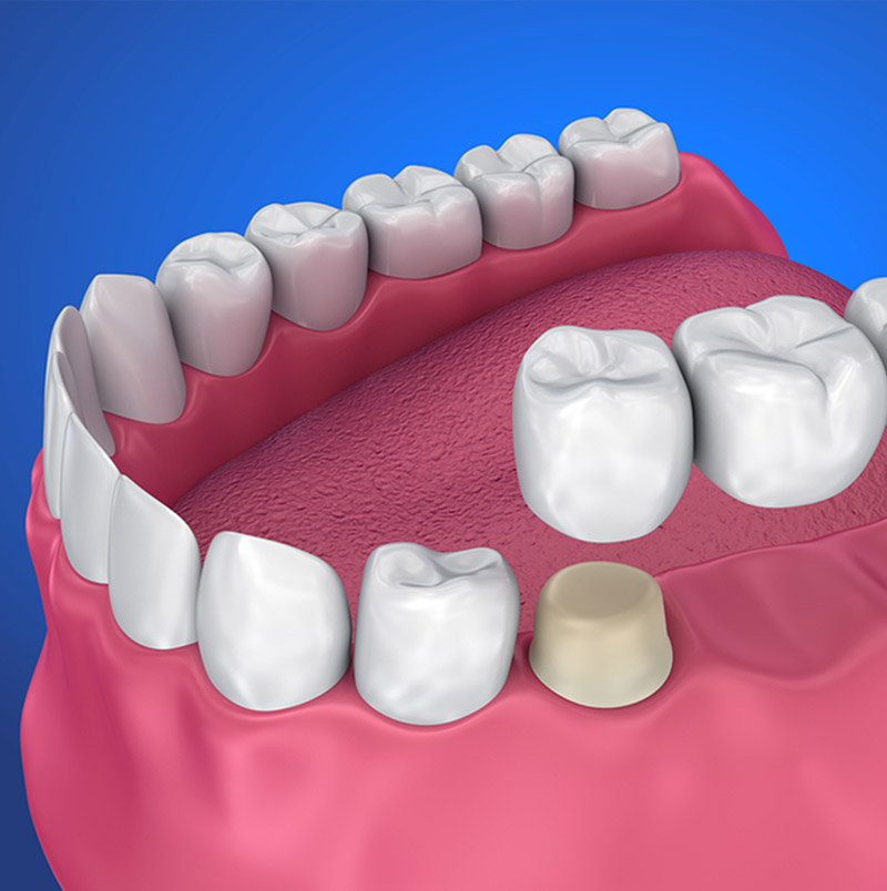 dental bridges in red deer