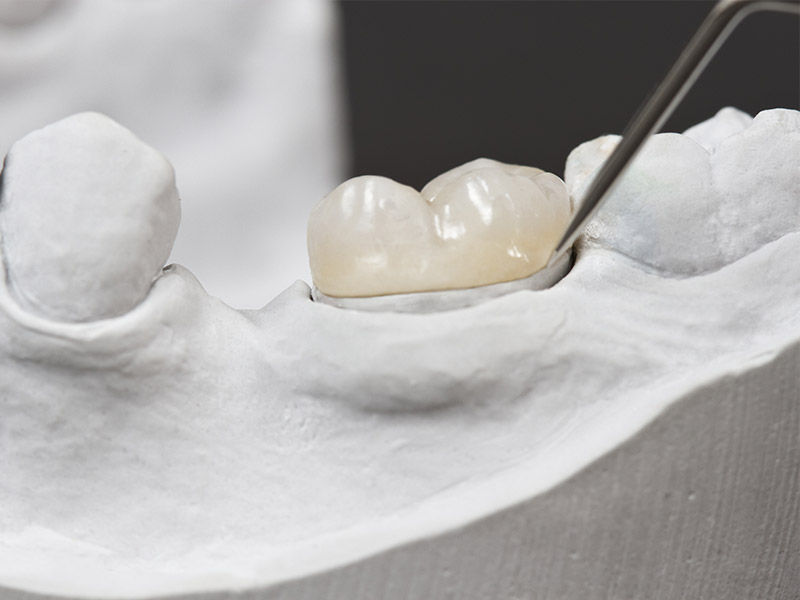 dental crowns in red deer