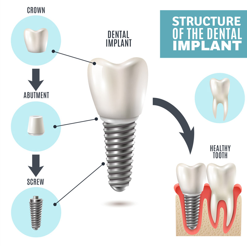 dental implants near you