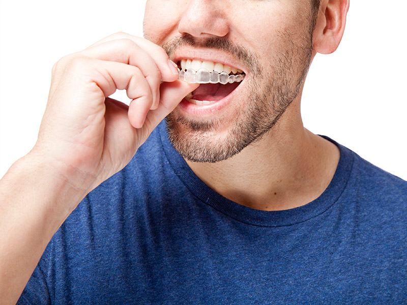 invisalign in red deer