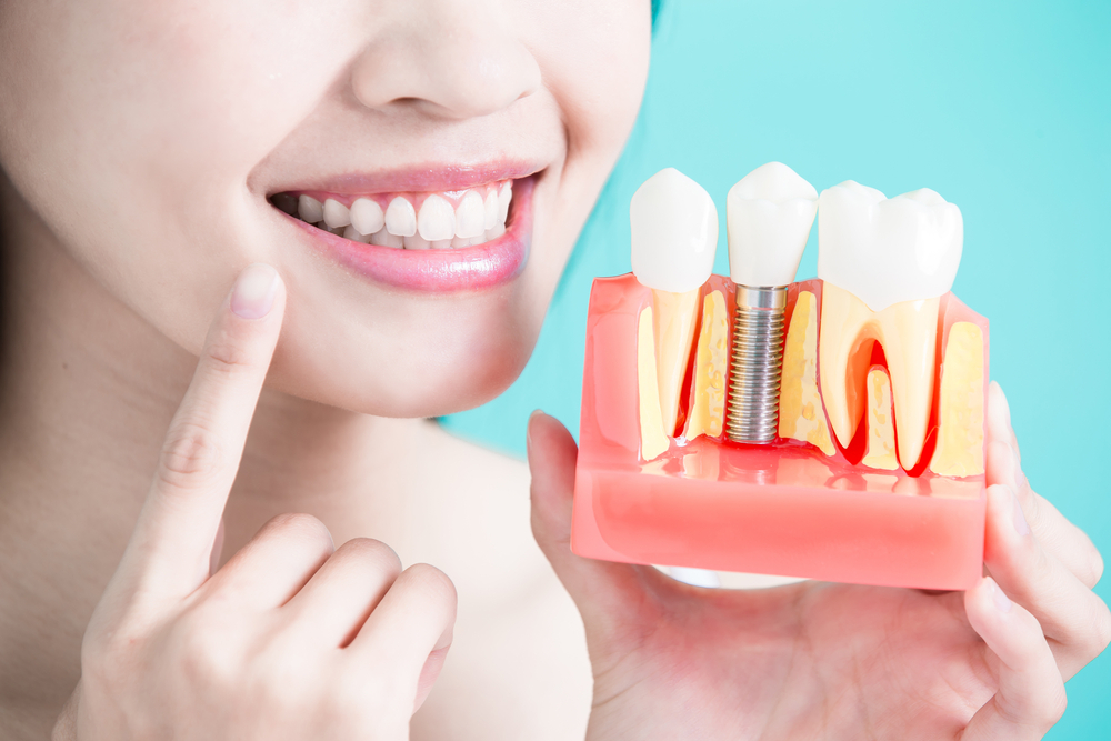 dental implants a step by step guide and expectations