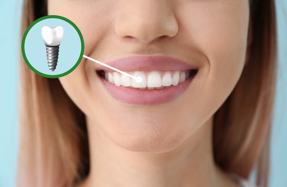 dental implants: what you need to know