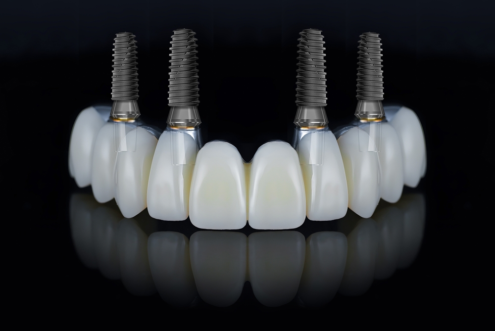 what is all on x and how does it replace missing teeth