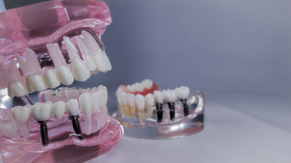 can dental implants replace multiple missing teeth